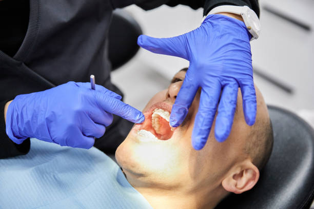 Best Knocked-Out Tooth (Avulsed Tooth) Treatment in St Cloud, FL